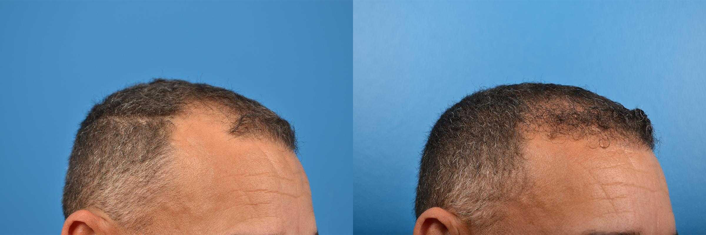 Hair Restoration Photos Melbourne, FL Patient 57493